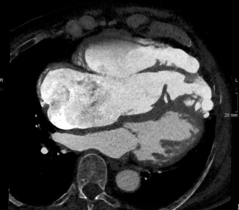 Herz-CT mit dezidiertem Kontrastmittelprotokoll bei einer Patientin mit schwerer Trikuspidalinsuffizienz zur Planung einer minimal-invasiven Klappenintervention.