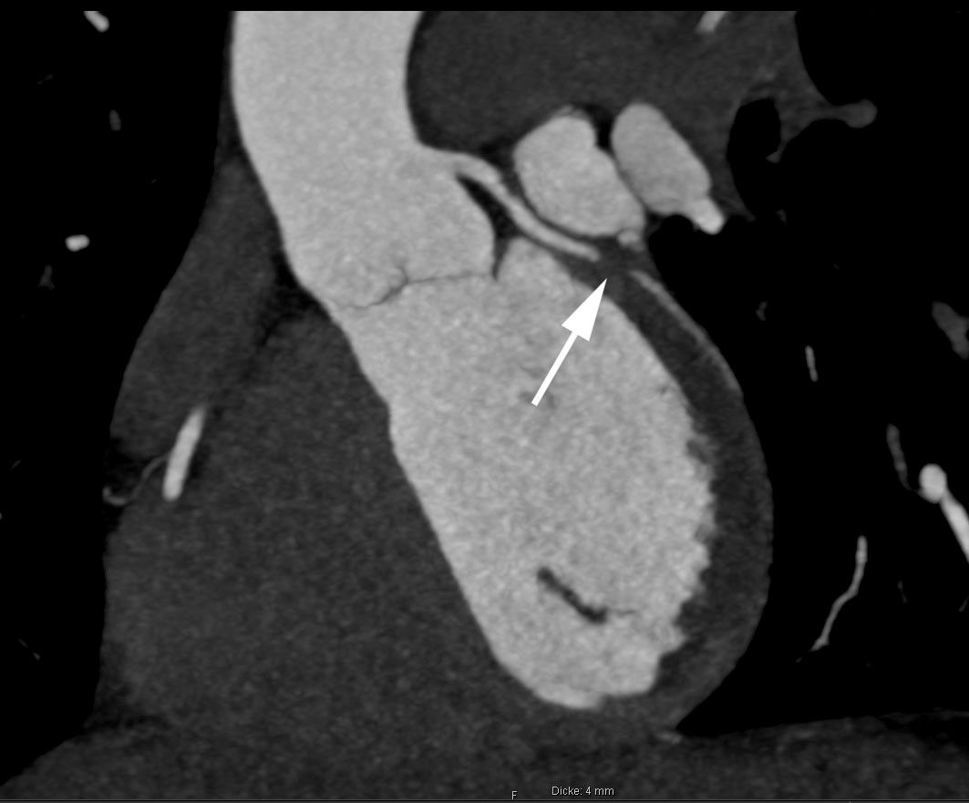 Herz-CT