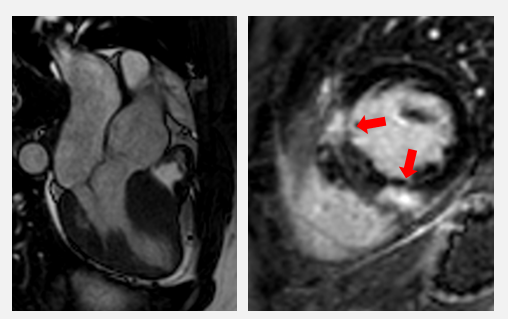 Herz-MRI eines Patienten mit HCM. Es zeigt sich eine deutliche Hypertrophie des Septums (links) sowie eine typische Fibrose, betont am Ansatz des rechten Ventrikels (rechts, rote Pfeile).