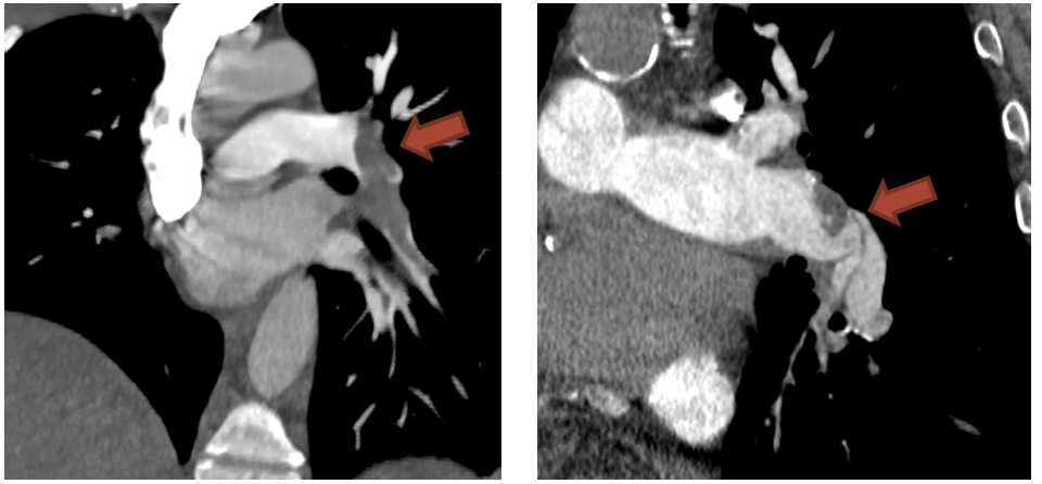 Lungenembolien mit Thromben