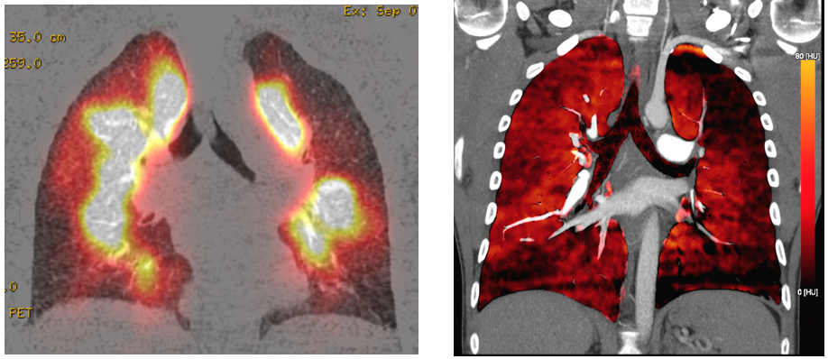 Perfusionsszinzigraphie (links) und Dual-Energy CT (rechts) desselben Patienten mit peripheren Perfusionsausfällen bei chronischer Lungenembolie.