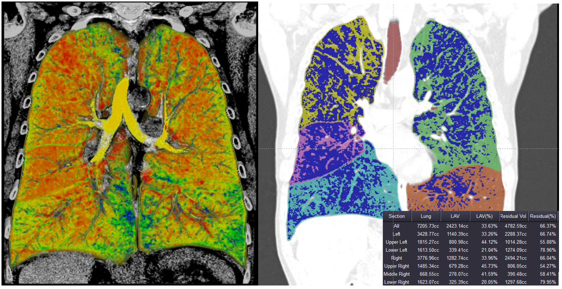 Lungendensitometrie zur Darstellung der Verteilung des Emphysems und Quantifizierung des Lungenemphysems