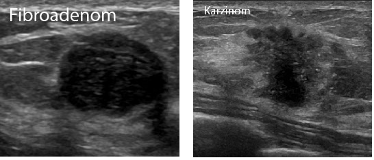 Fibroadenom und Karzinom