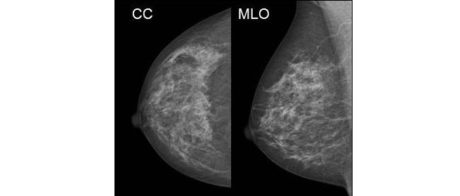 Projektionen der Mammografie aufnahme