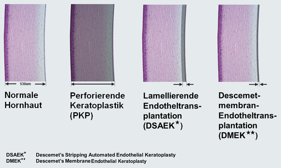 Verfahren der Hornhauttransplantation, Illustration