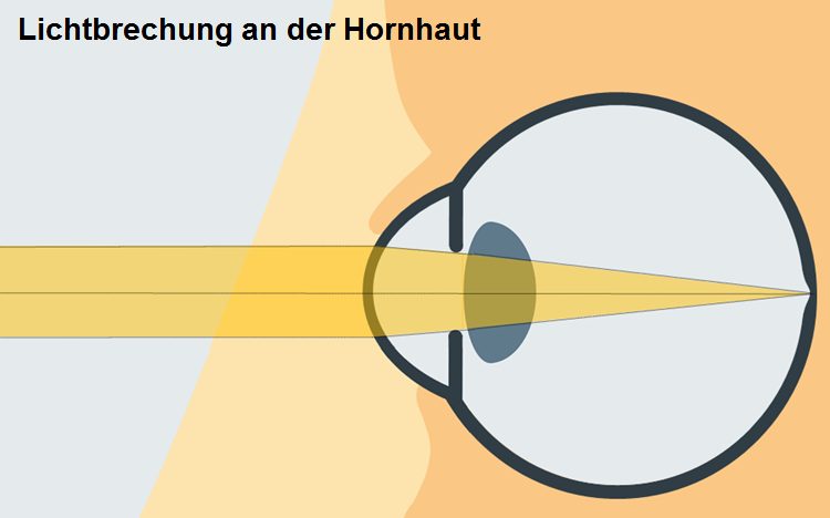 Illustration Lichtbrechung an der Hornhaut