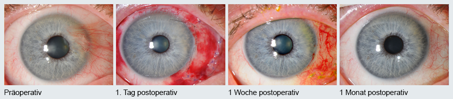 postoperative Verlauf nach Pterygium-Exzision