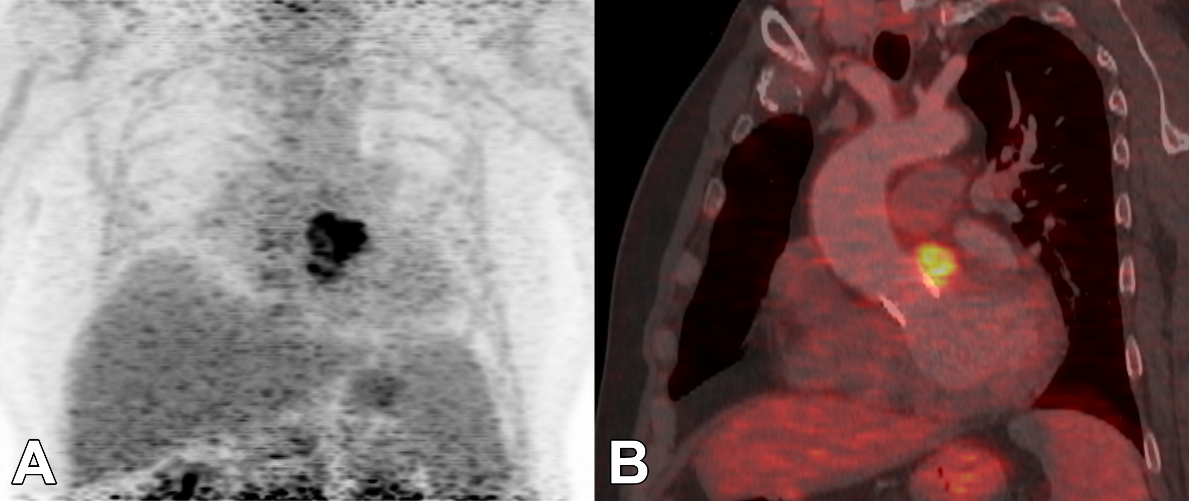 63-year-old patient after biological aortic valve replacement. Echocardiographic with probable paravalvular abscess that can be clearly diagnosed using 18F-FDG PET / CT. Maximum intensity projection (MIP) with clear focal metabolic activity projected onto the aortic root (A), which can be clearly localized in the series fused with the CT (B). Surgical confirmation of a large posterior wall abscess.